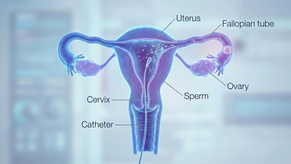 ما هو تغدد الرحم؟ فهم الأعراض وطرق العلاج