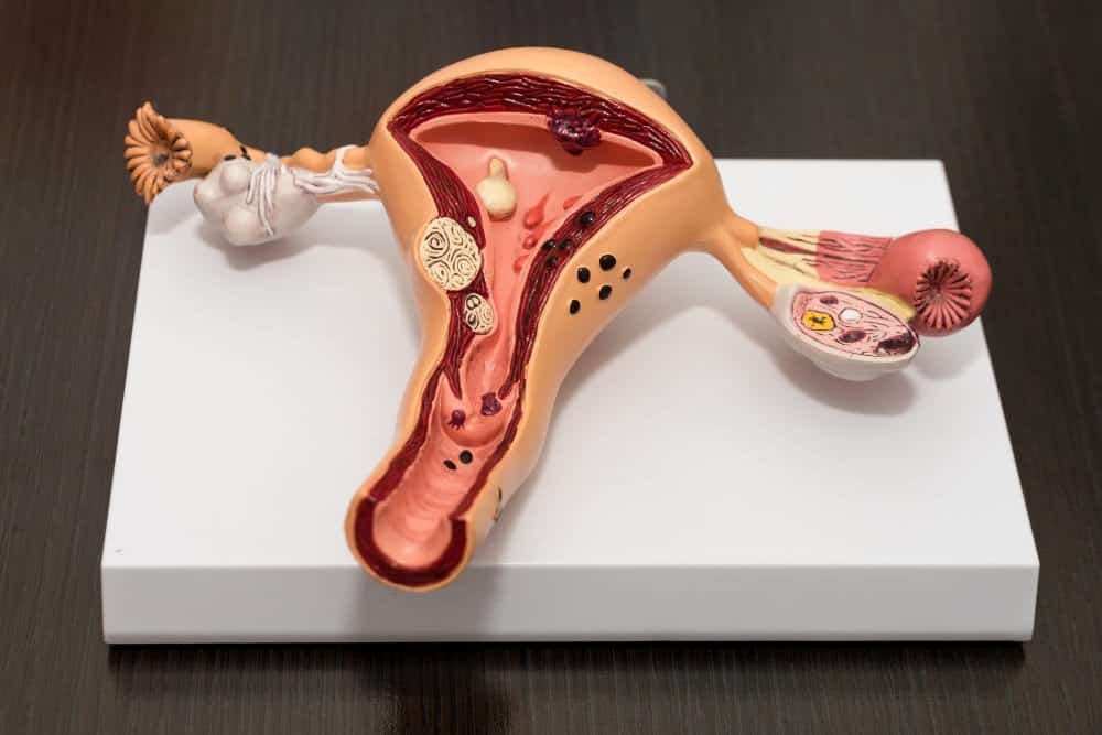 Adenomyosis Stage 4 Symptoms