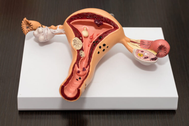 Can adenomyosis be removed without a hysterectomy? Your Options Explained