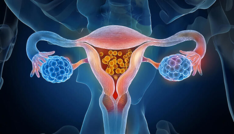 Adenomyosis Bleeding Between Periods: Causes, Symptoms, and Solutions