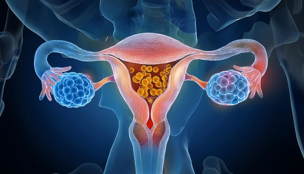 Adenomyosis Bleeding Between Periods: Causes, Symptoms, and Solutions