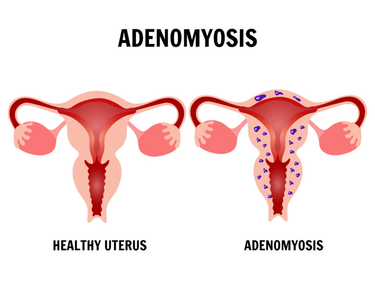 هل غدد الرحم خطيرة؟ هل يحدث حمل مع وجود تغدد رحمي؟