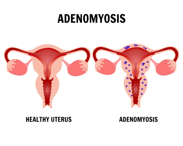 هل غدد الرحم خطيرة؟ هل يحدث حمل مع وجود تغدد رحمي؟