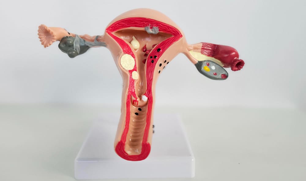 هل عملية قسطرة الرحم تمنع الحمل؟