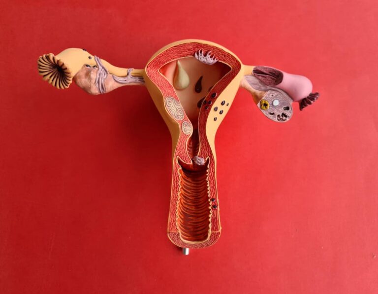 Adenomyosis Stage 4 Symptoms: What Women Need to Know?