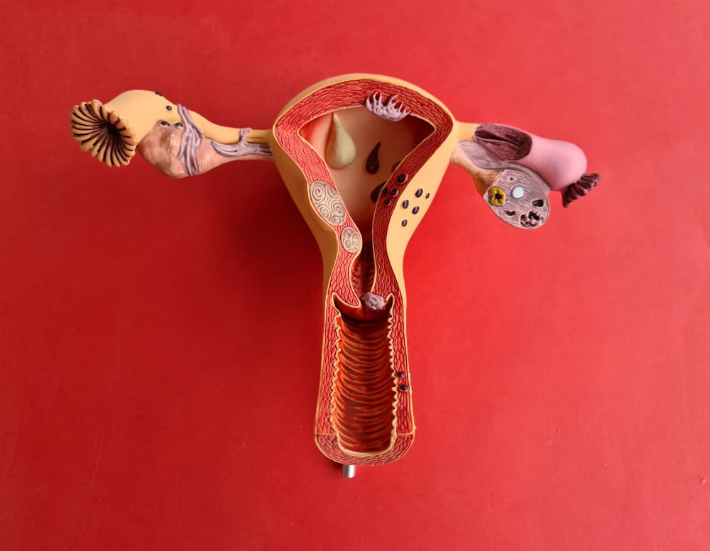 Adenomyosis Stage 4 Symptoms: What Women Need to Know?