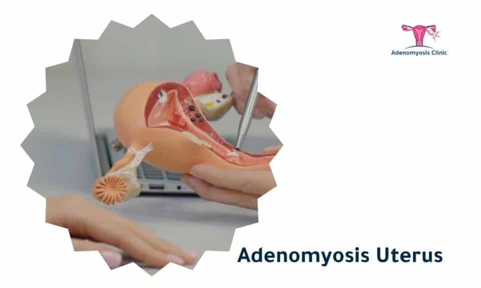 Adenomyosis Uterus Symptoms And Causes And Treatment Adenomyosis Clinic