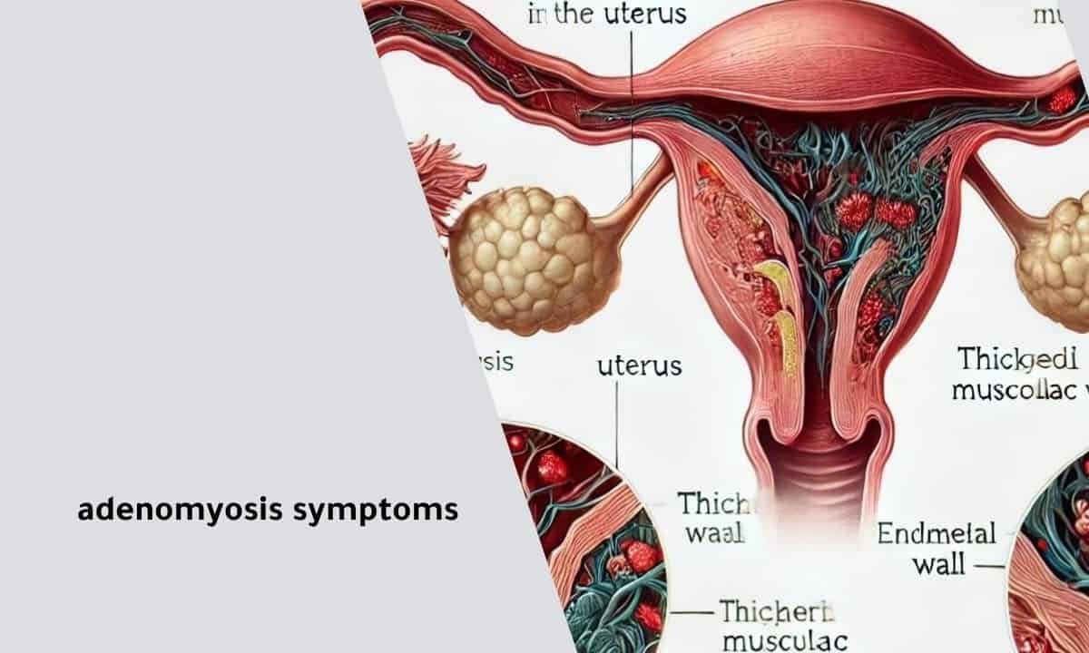 Adenomyosis Symptoms