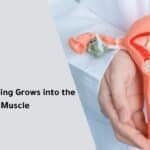 Uterine Lining Grows into the Muscle