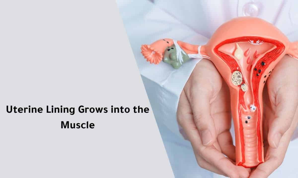 Uterine Lining Grows into the Muscle