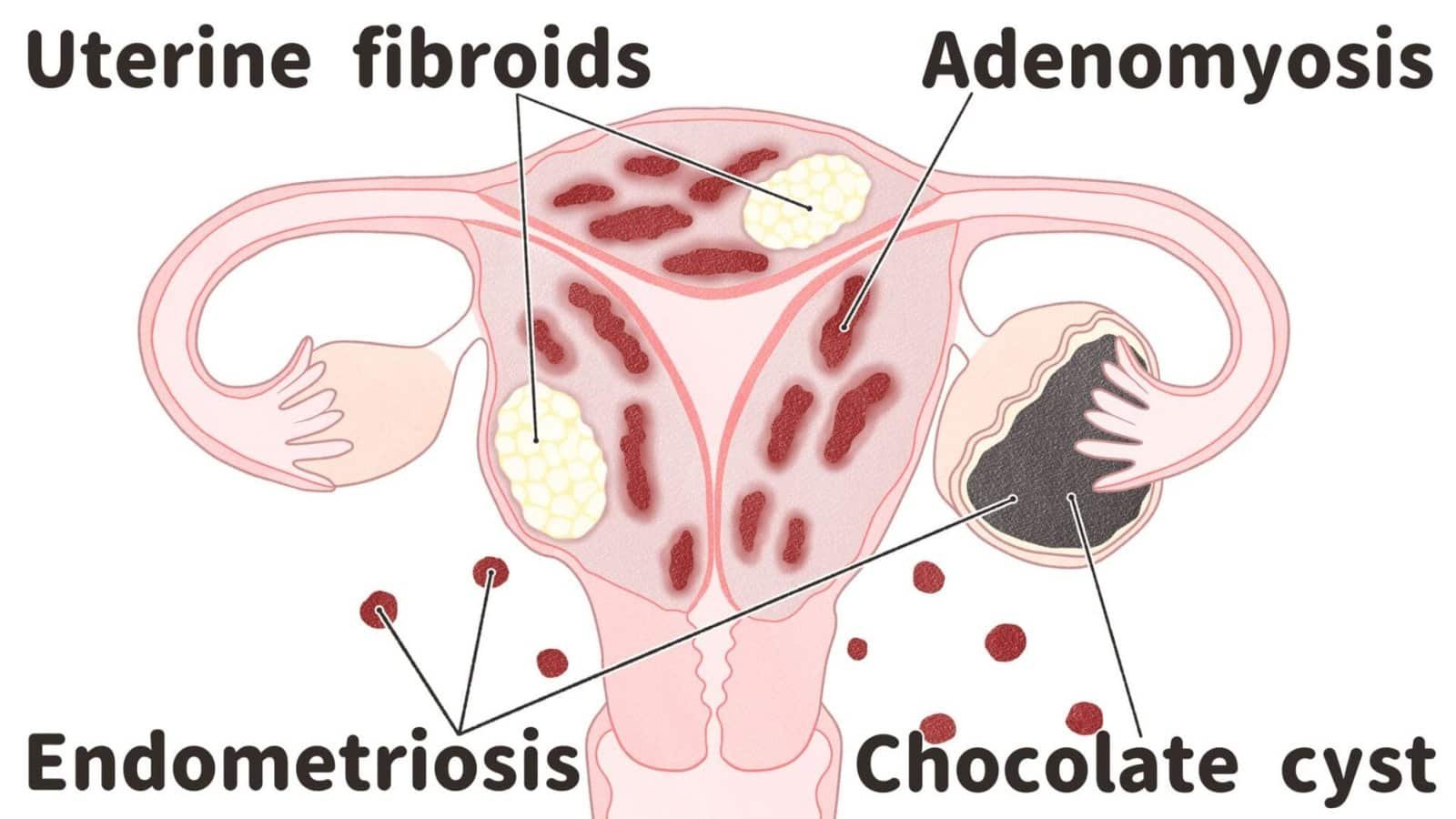 التغدد والتليف الرحمي