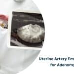 Uterine Artery Embolization for Adenomyosis: A Treatment Invasive Solution