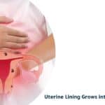 Uterine Lining Grows Into The Muscle
