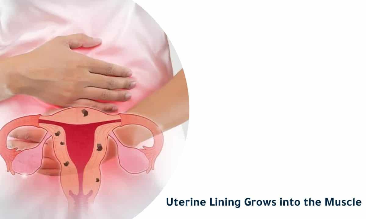 Uterine Lining Grows Into The Muscle