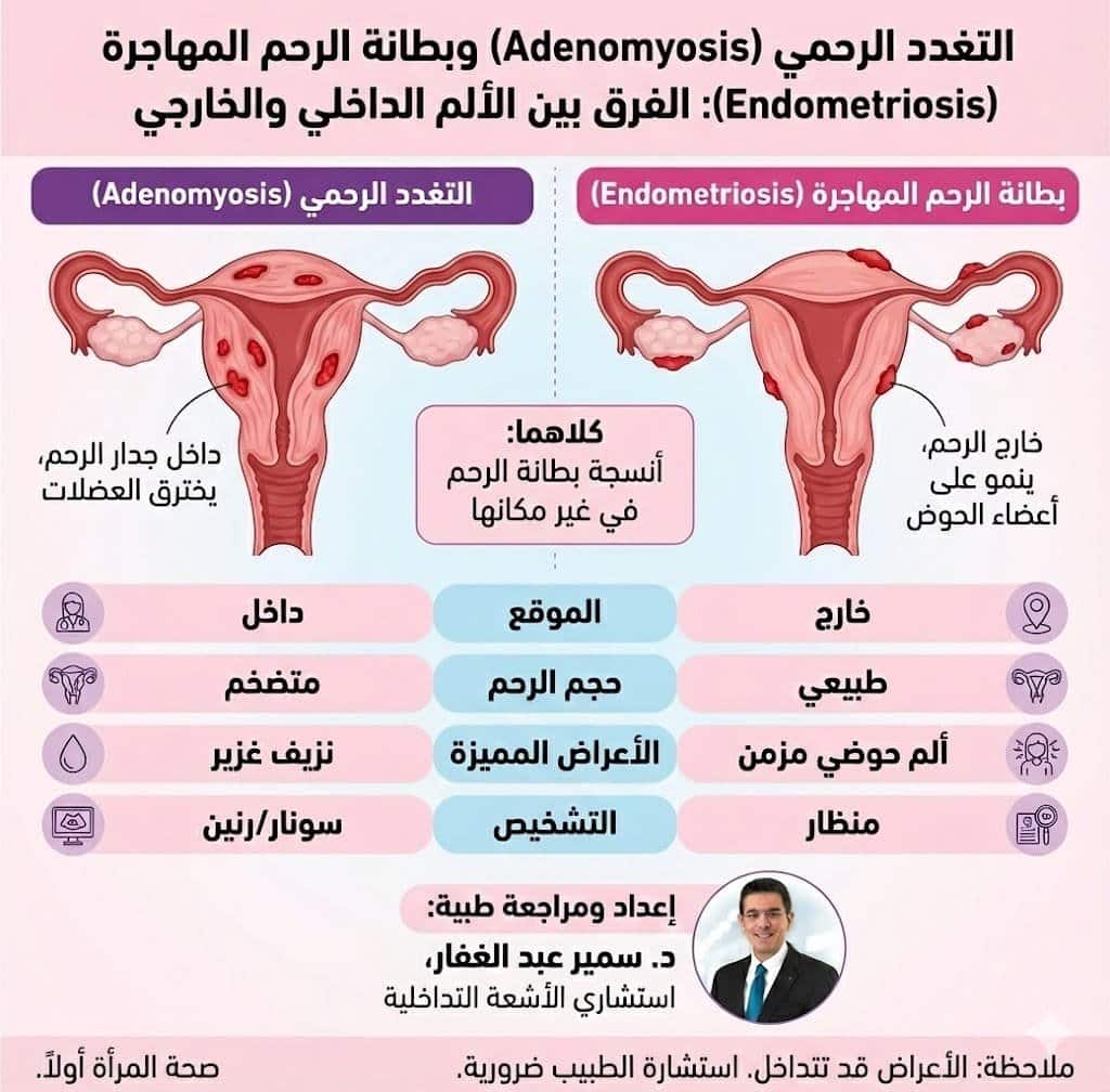 الفرق الجوهري بين التغدد الرحمي وبطانة الرحم المهاجرة